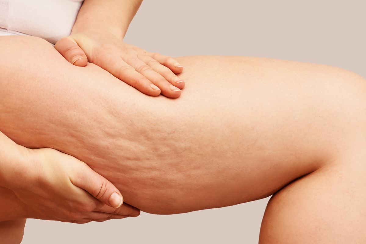cellulite aux cuisses