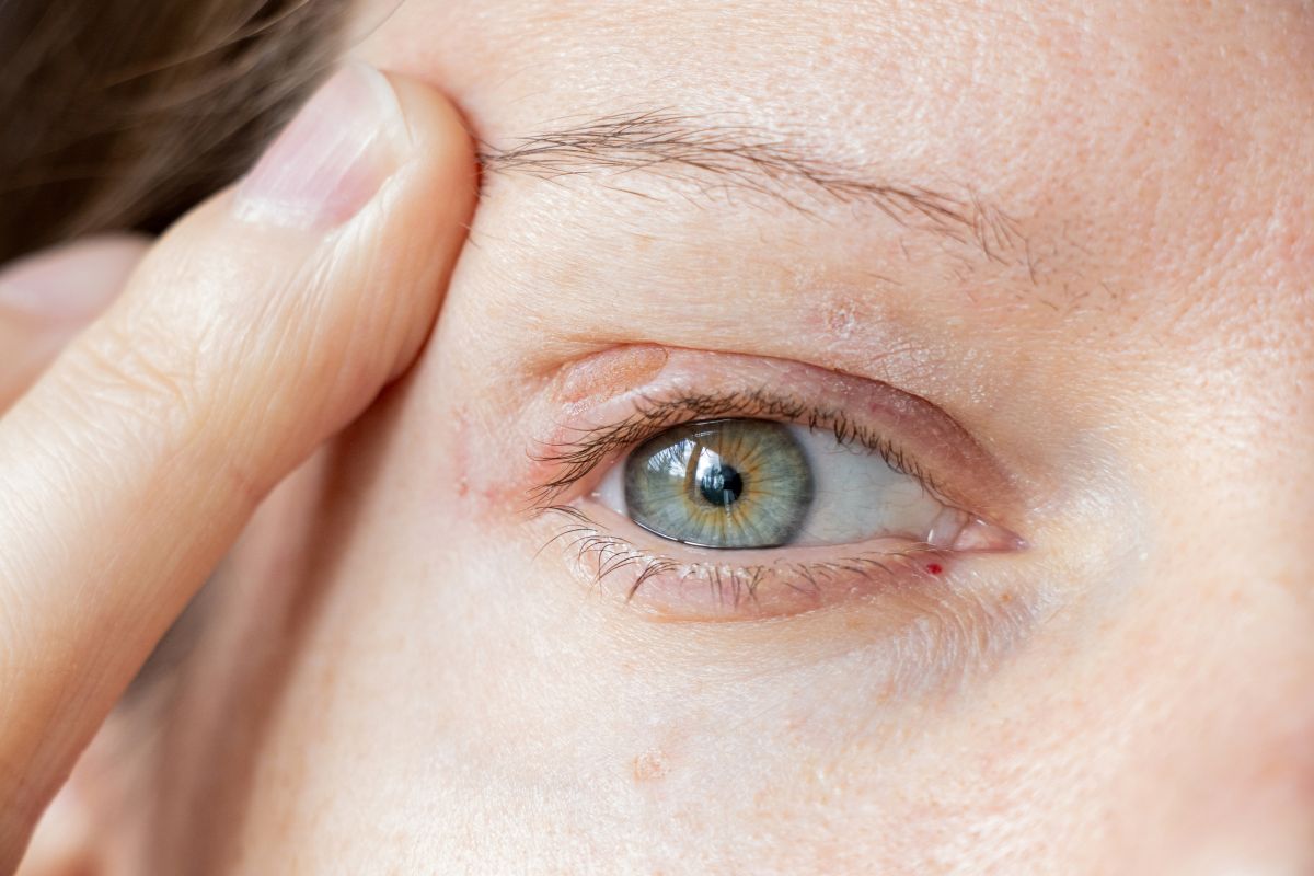 chirurgie des paupières au laser 