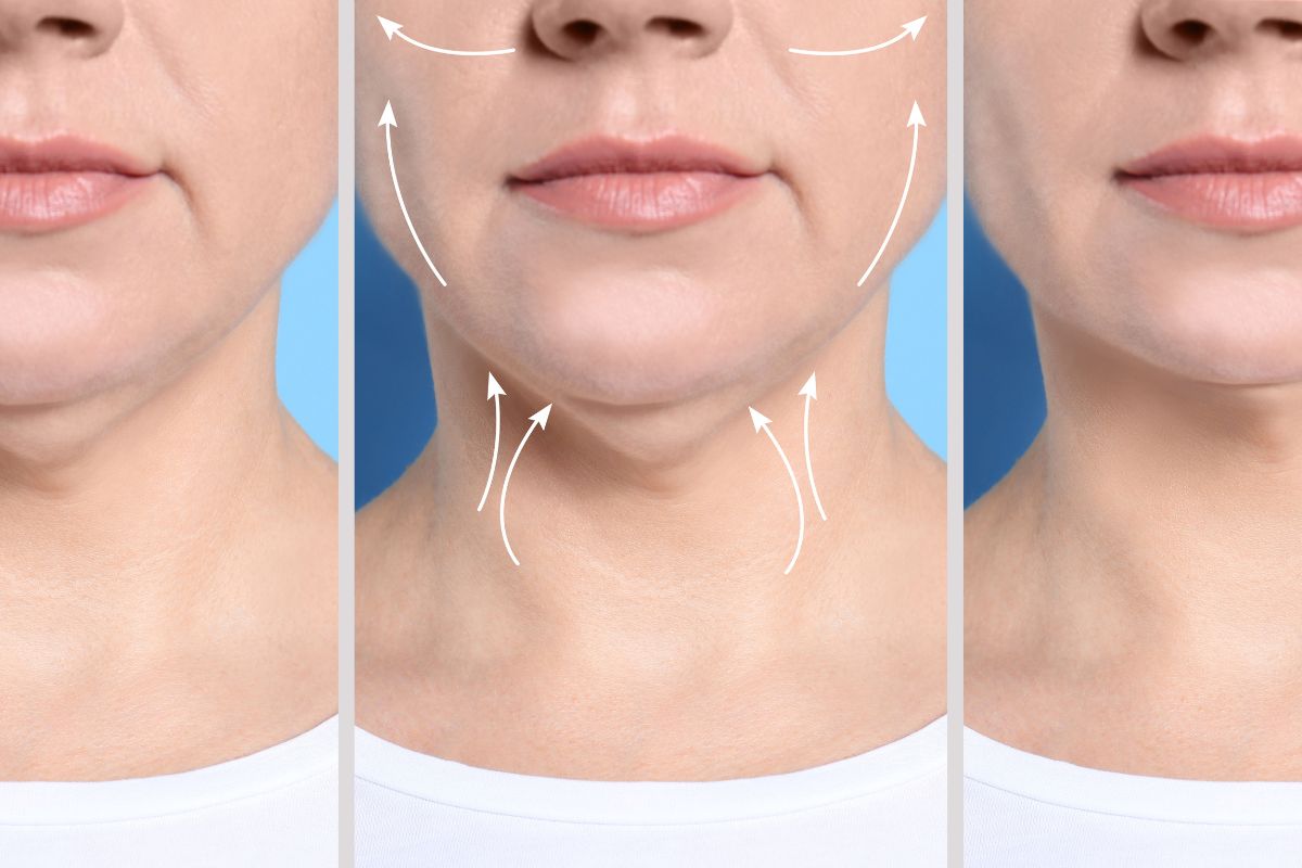 tarifs de la chirurgie du double menton 