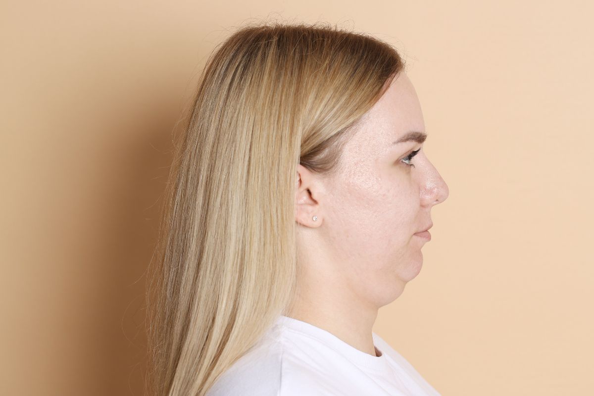 chirurgie du double menton